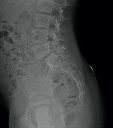 Radiographie d'un spondylolisthesis stable