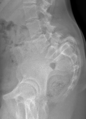 Radiographie d'un spondylolisthesis instable