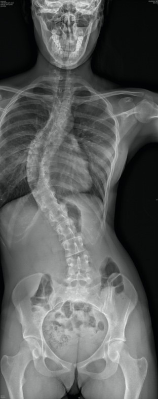 Radiographie avant chirurgie de la scoliose idiopathique