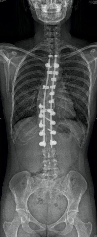 Radiographie avant chirurgie de la scoliose idiopathique