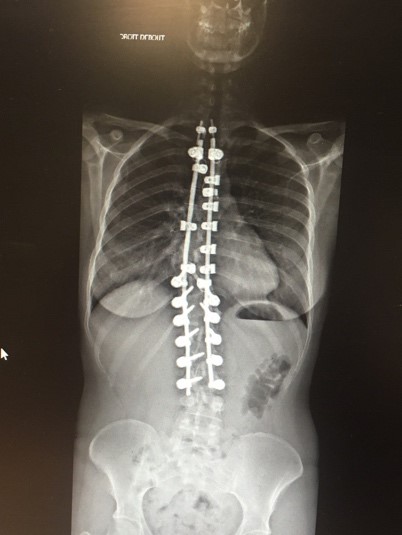 Radiographie post opératoire de la scoliose idiopathique de face